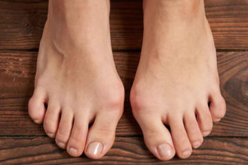 celebrities with bunions